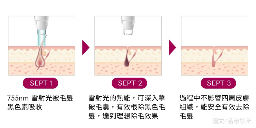 雷射除毛