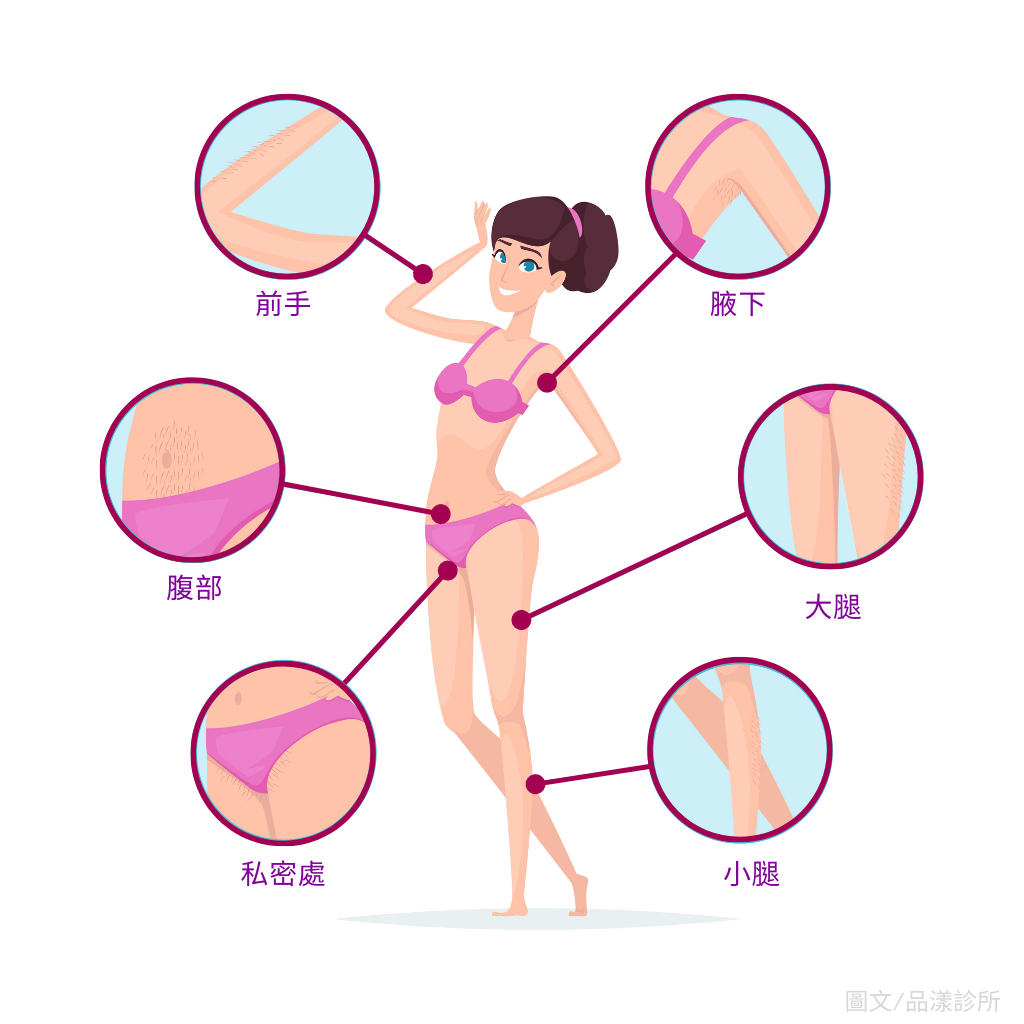 亞歷山大雷射除毛適用於全身各部位