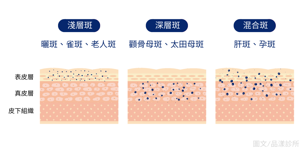 斑點存在不同肌膚層次