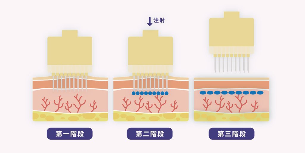 水光注射原理