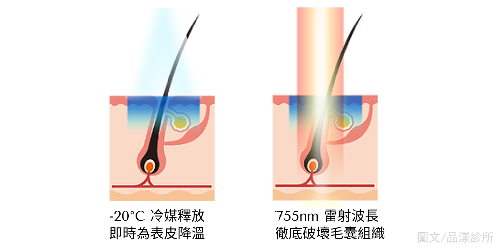 雷射除毛原理:溫度與755mm波長針對毛髮原理示意圖