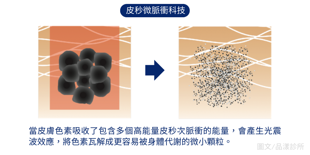 皮秒雷射微脈衝光震效應