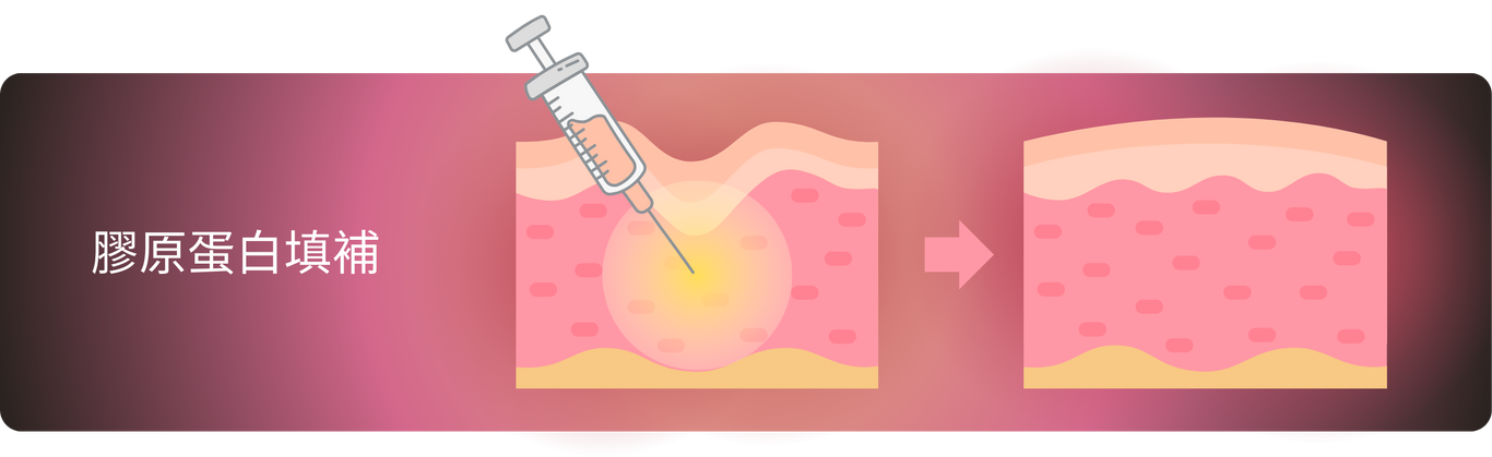 膠原蛋白針填補