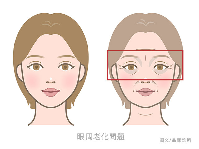 眼周老化 640x480